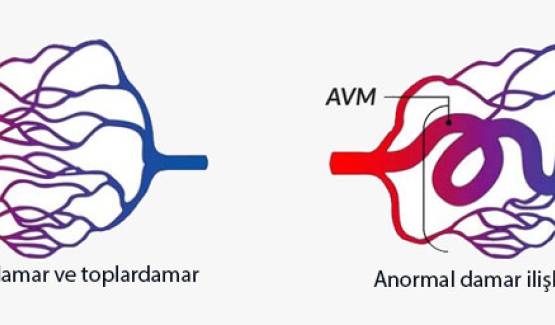 Arteriovenöz malformasyon (AVM)