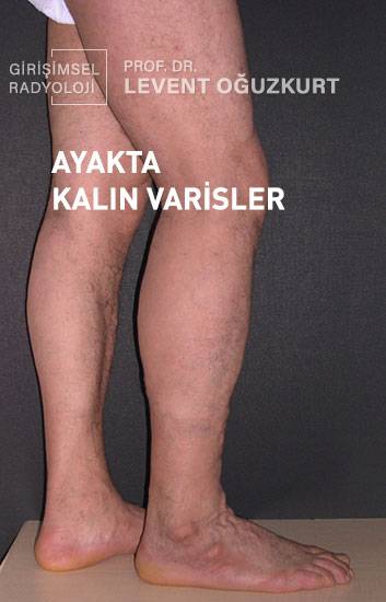 Ayakta belirginleşen kalın varisler