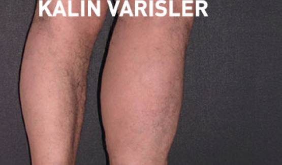 Varis belirtileri