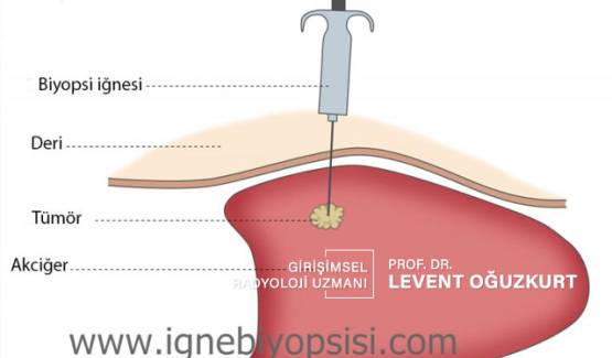 İğne biyopsisi nasıl yapılır?
