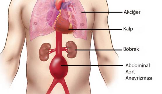 Abdominal aort anevrizması