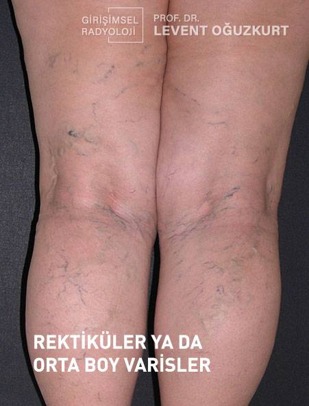 Orta boy (retiküler) varis