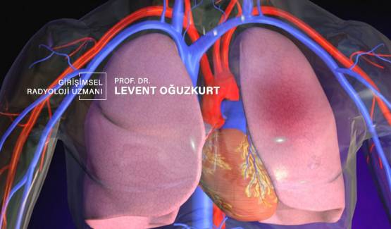 Pulmoner emboli