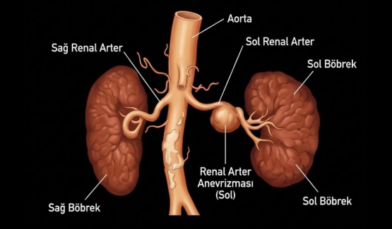 Renal arter anevrizması