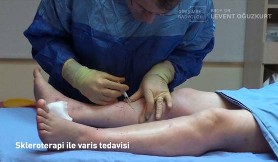 Skleroterapi nedir?
