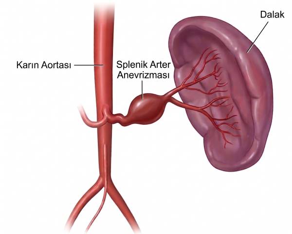Karın aortası, dalak ve splenik arter anevrizmasını gösteren çizim