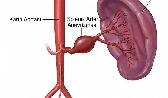 Splenik arter anevrizması