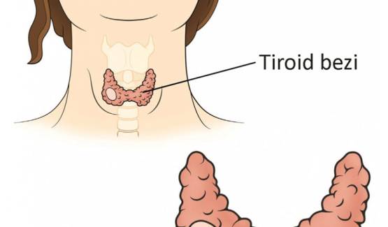 Tiroid nodülü nedir?